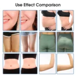 www.hktmay.com_cryolipolyis_TM-922D_Tingmay Criolipolisis Machine_Before and After