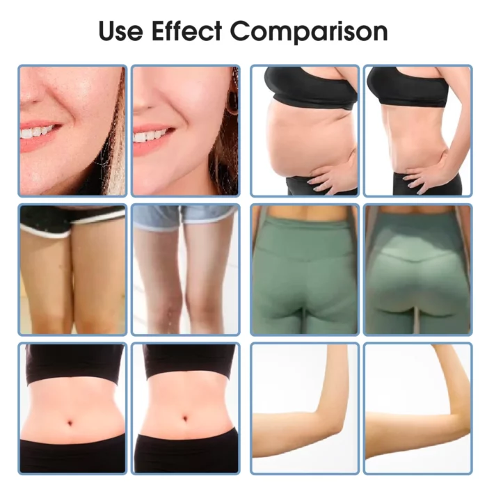 www.hktmay.com_cryolipolyis_TM-922D_Tingmay Criolipolisis Machine_Before and After