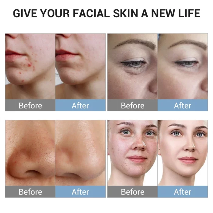 www.hktmay.com_hydrofacial_TM-H8_Tingmay Multi-Functional Hydrodermabrasion Machine_Before and After