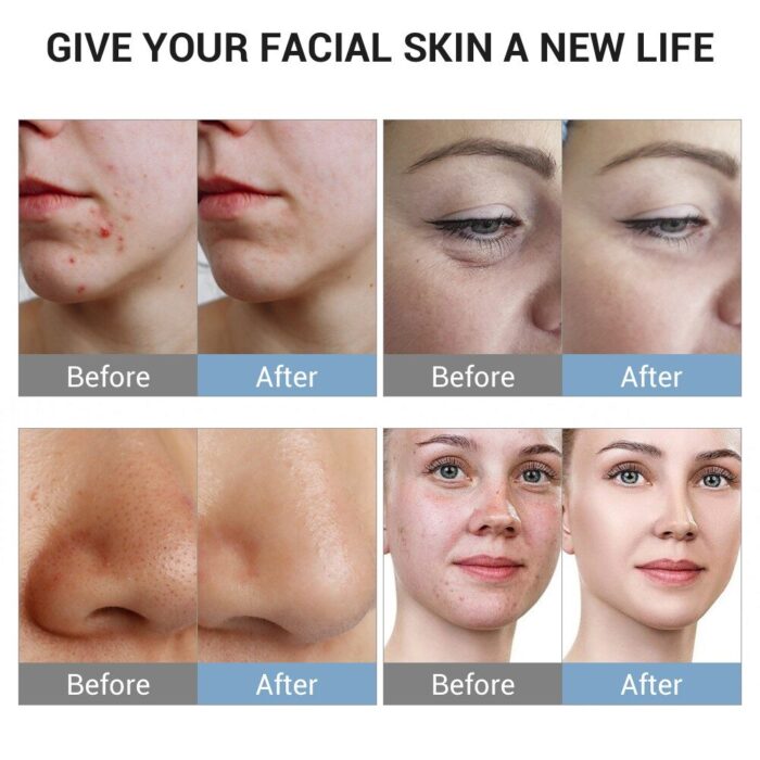 Tingmay 6 in 1 Oxygen Hydrodermabrasion Facial Beauty Machine - Image 7