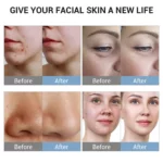www.hktmay.com_hydrofacial_TM-QY6.0_Tingmay 360 Visual Hydra Dermabrasion Machine_before and after