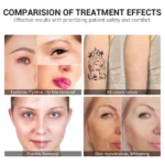 www.hktmay.com_laser tattoo removal_TM-J108_Tingmay Nd Yag Tattoo Removal Laser Machine_Before and After