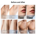 www.hktmay.com_TM-E133_Diode Laser Hair Removal Machine_Before and After Result