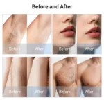 www.hktmay.com_Multi-functional Laser_TM-E133 A1_Tingmay 2-in-1 Diode & PicoLaser Tattoo Removal Equipment_Before and After Result