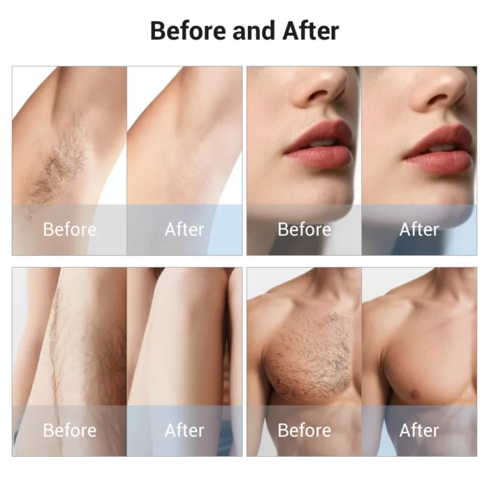 www.hktmay.com_Multi-functional Laser_TM-E133 A1_Tingmay 2-in-1 Diode & PicoLaser Tattoo Removal Equipment_Before and After Result