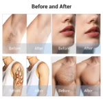 www.hktmay.com_multi functional laser_TM-808A Diode Laser Hair Removal Picosecond Tattoo Laser Removal Machine_Before and After