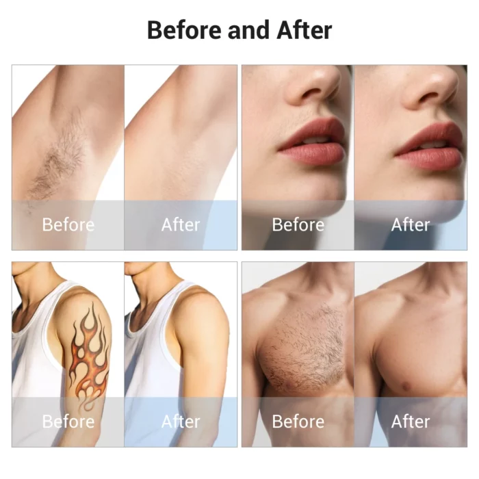 www.hktmay.com_multi functional laser_TM-808A Diode Laser Hair Removal Picosecond Tattoo Laser Removal Machine_Before and After