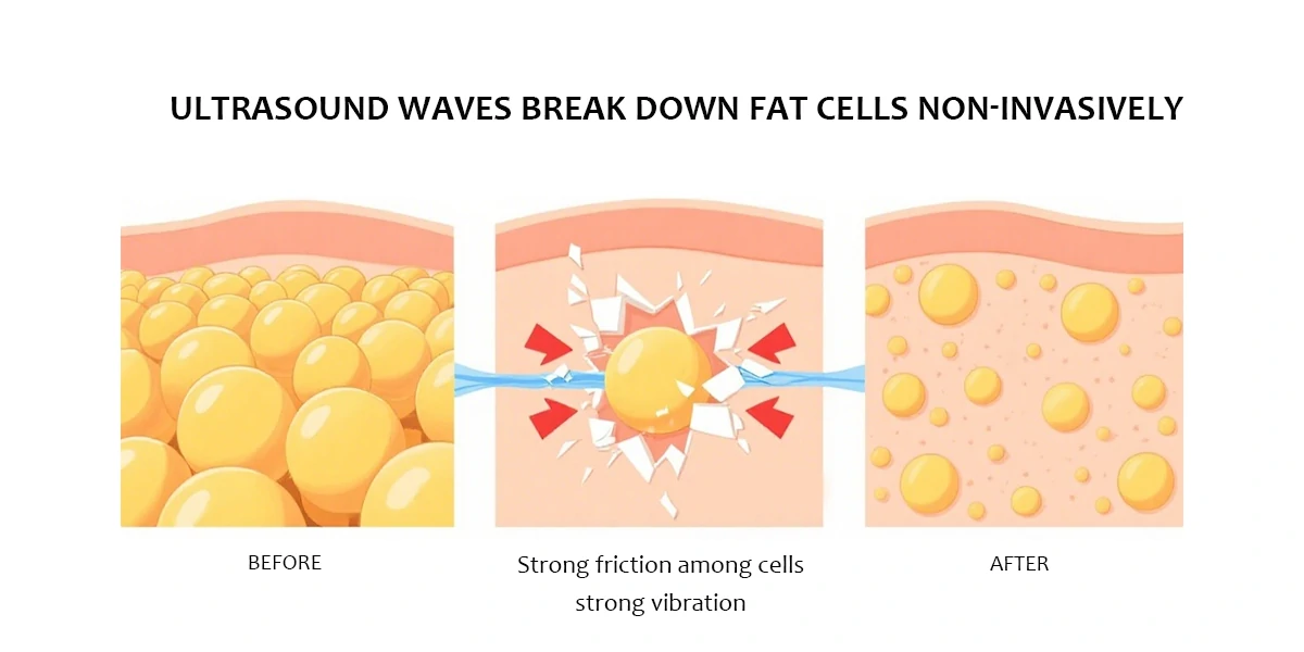 How doee ultrasonic cavitation work?