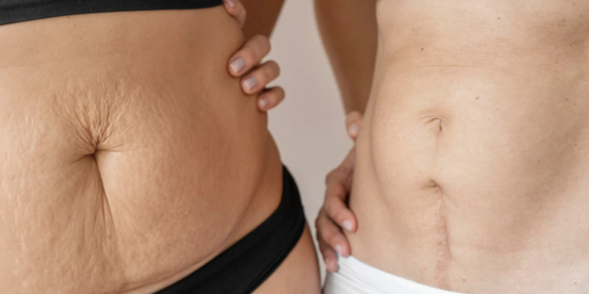 www.hktmay.Acom_blog__Laser Stretch Mark Removal: Does It Really Work?_03