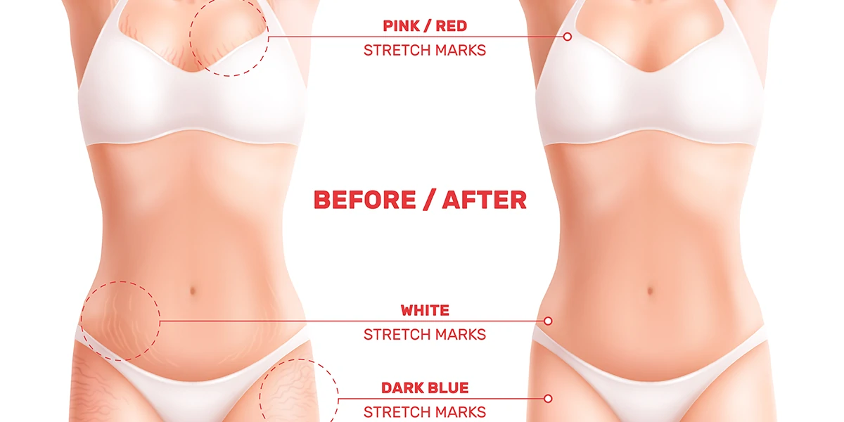 www.hktmay.Acom_blog__Laser Stretch Mark Removal: Does It Really Work?_04