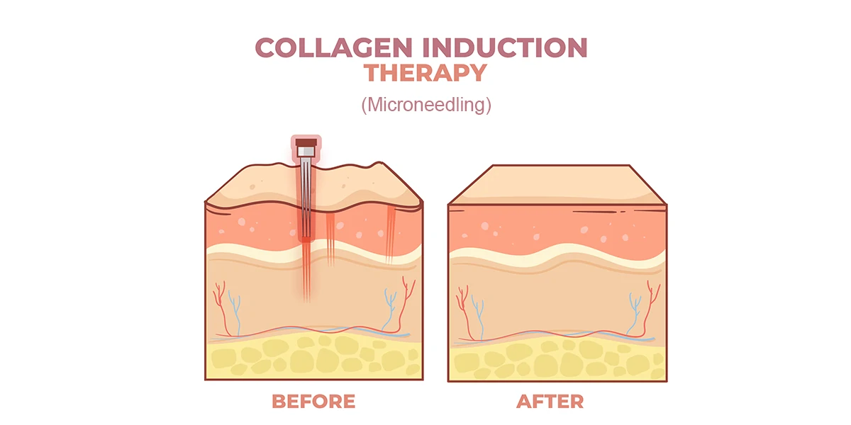 Collegen induction therepay(microneedlilng)