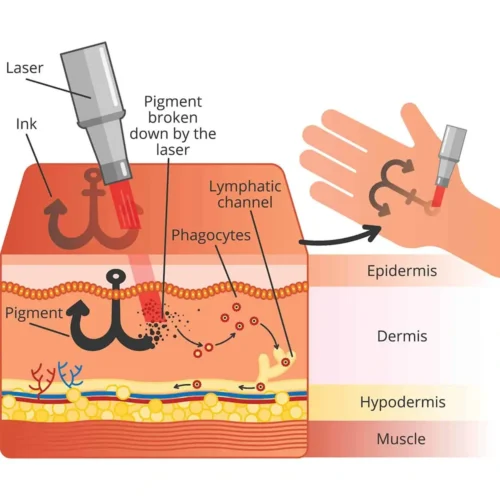 working principle of laser tattoo removal